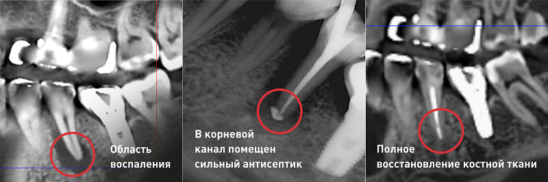 сохранить сложный зуб