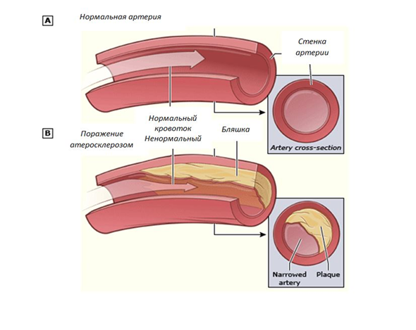 Симптомы атеросклероза сосудов шеи, головы, коронарных артерий