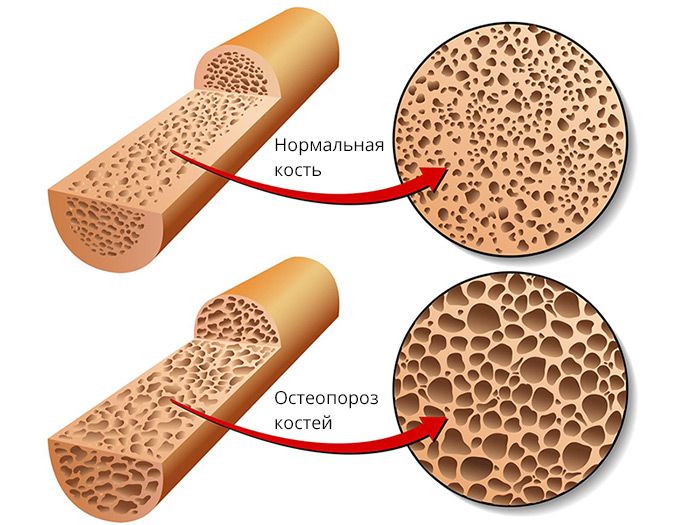 Остеопороз — симптомы и лечение