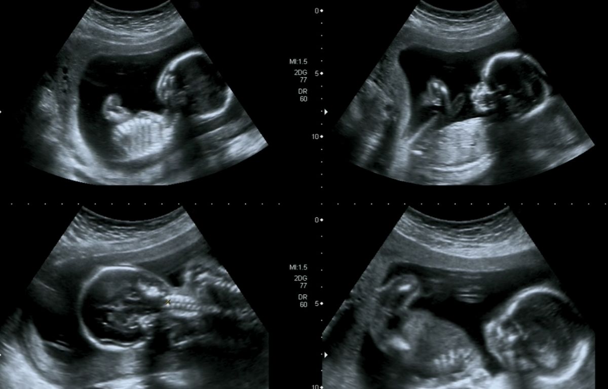 Фото малыша в утробе в 20 недель