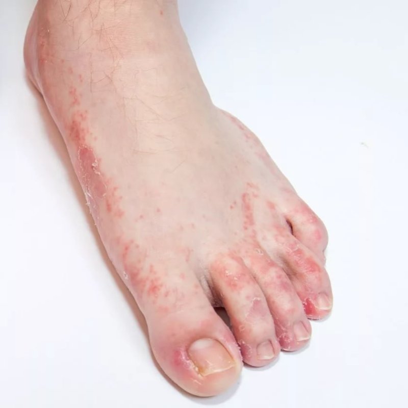 Сыпь на коже у ребенка – причины и способы лечения