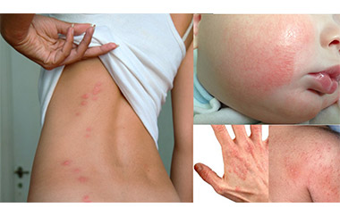 Дерматомикозы – грибковые заболевания кожи