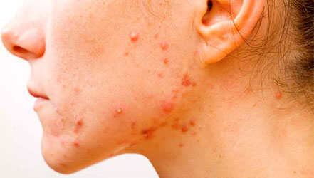 Ксероз кожи: причины, симптомы и лечение заболевания