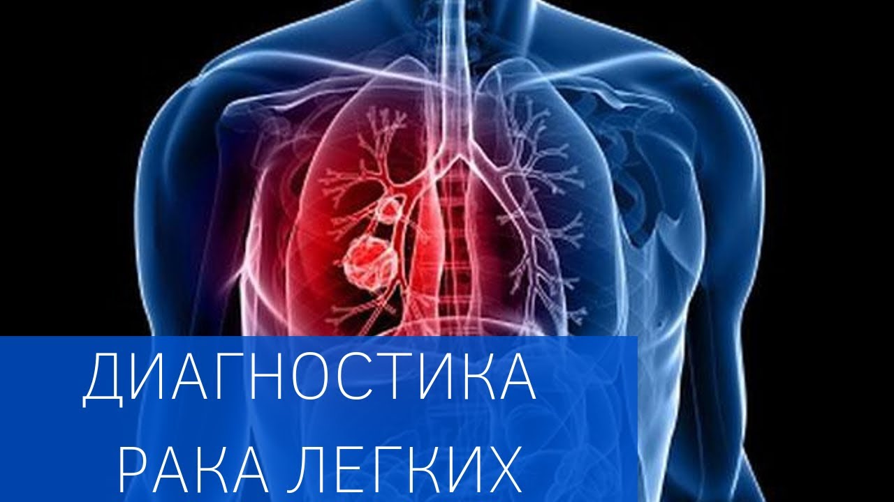 О ранней диагностике рака легких 