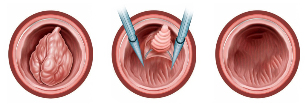 Удаление полипа шейки матки