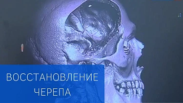 Операция по восстановлению черепа