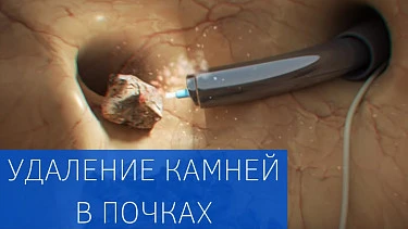 Мочекаменная болезнь: удаление камней и лечение почечной колики 