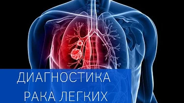 О ранней диагностике рака легких 