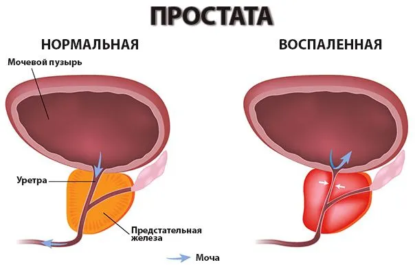 Основные препараты для лечения простатита у мужчин